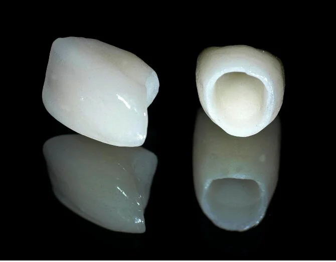 How much does a dental crown cost in Toronto? Atlas Dental