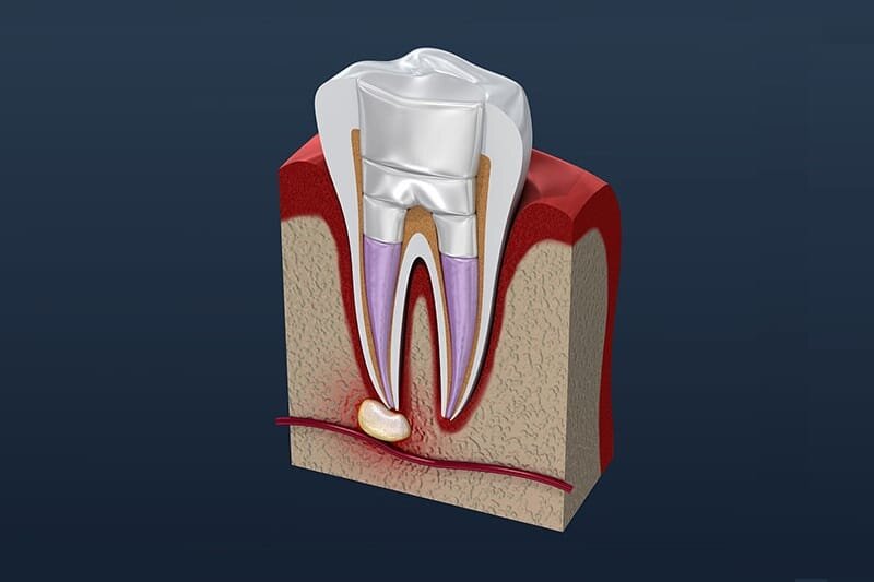 root canal