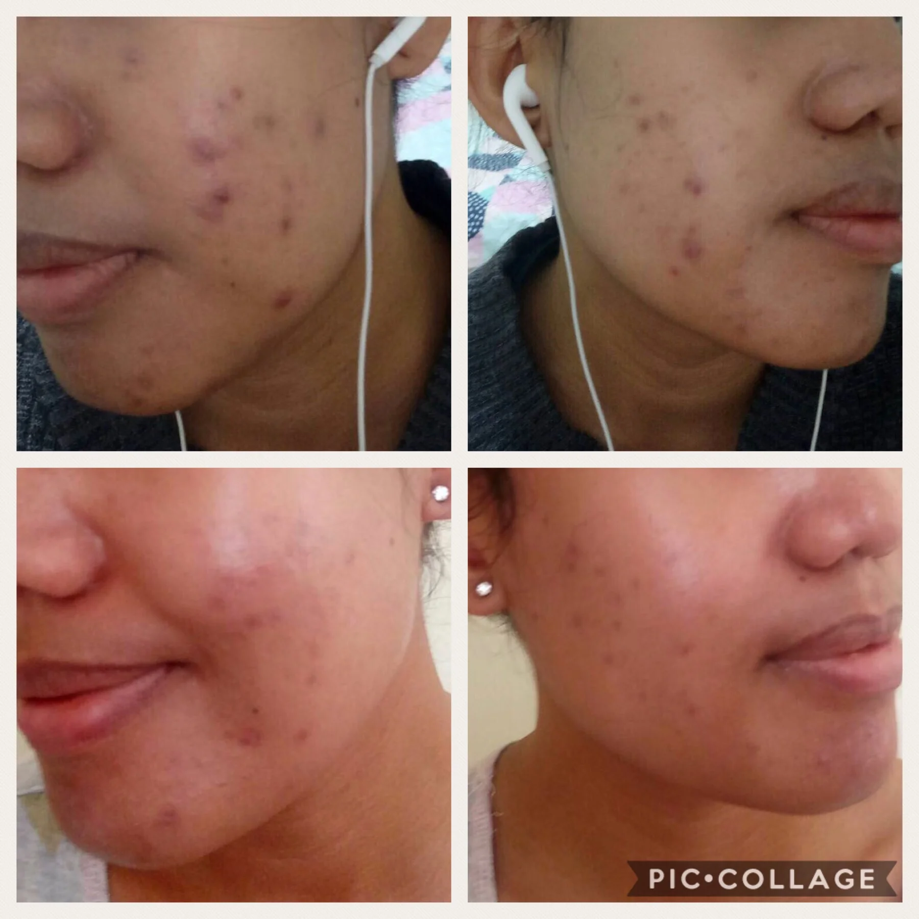 Is IPL effective in treating acne, ageing skin, rosacea & scarring.?