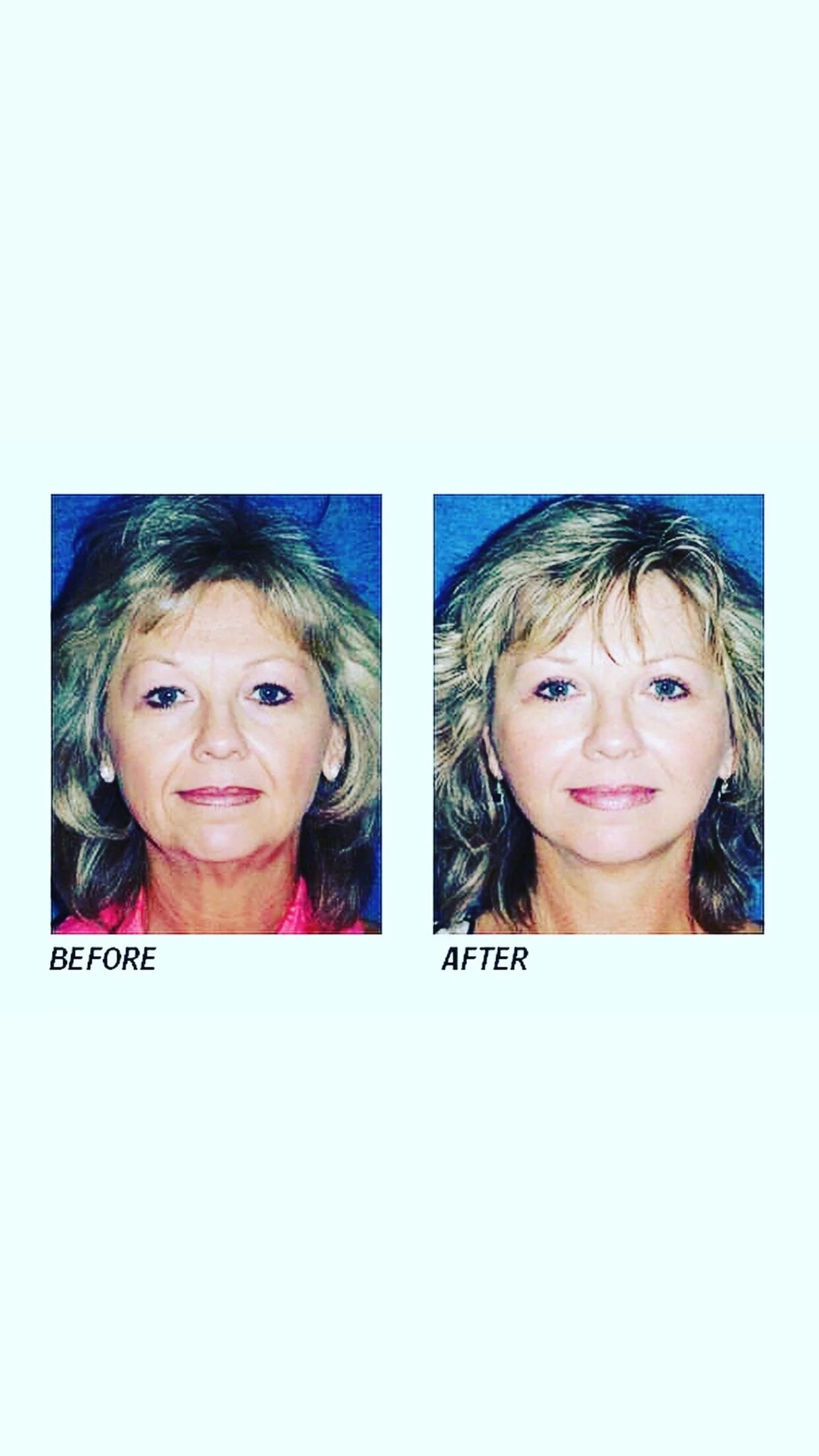 Radio frequency facial