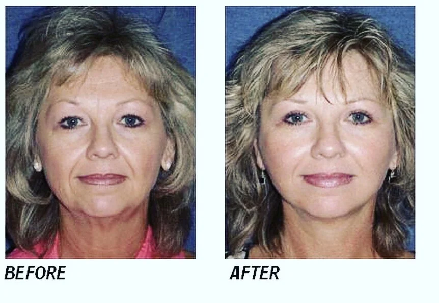 The radio frequency non-surgical facelift