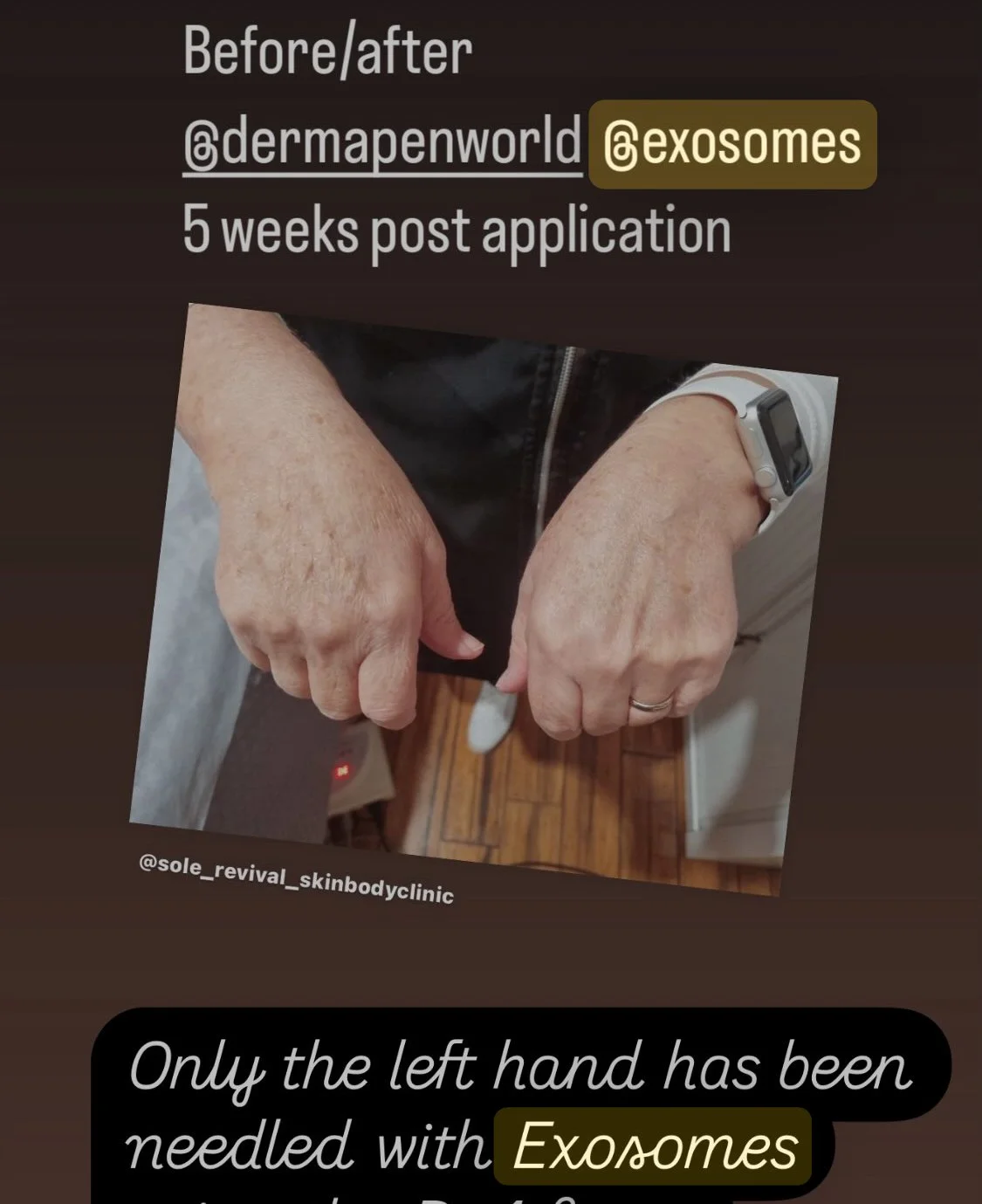 Dermapen4 skin needling with Exosomes