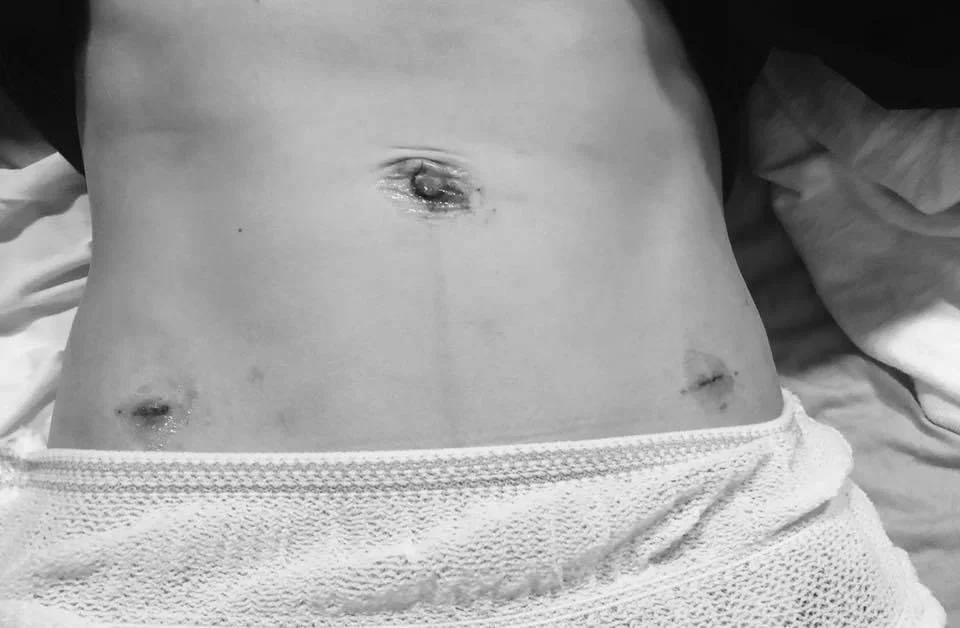 An Ectopic Pregnancy