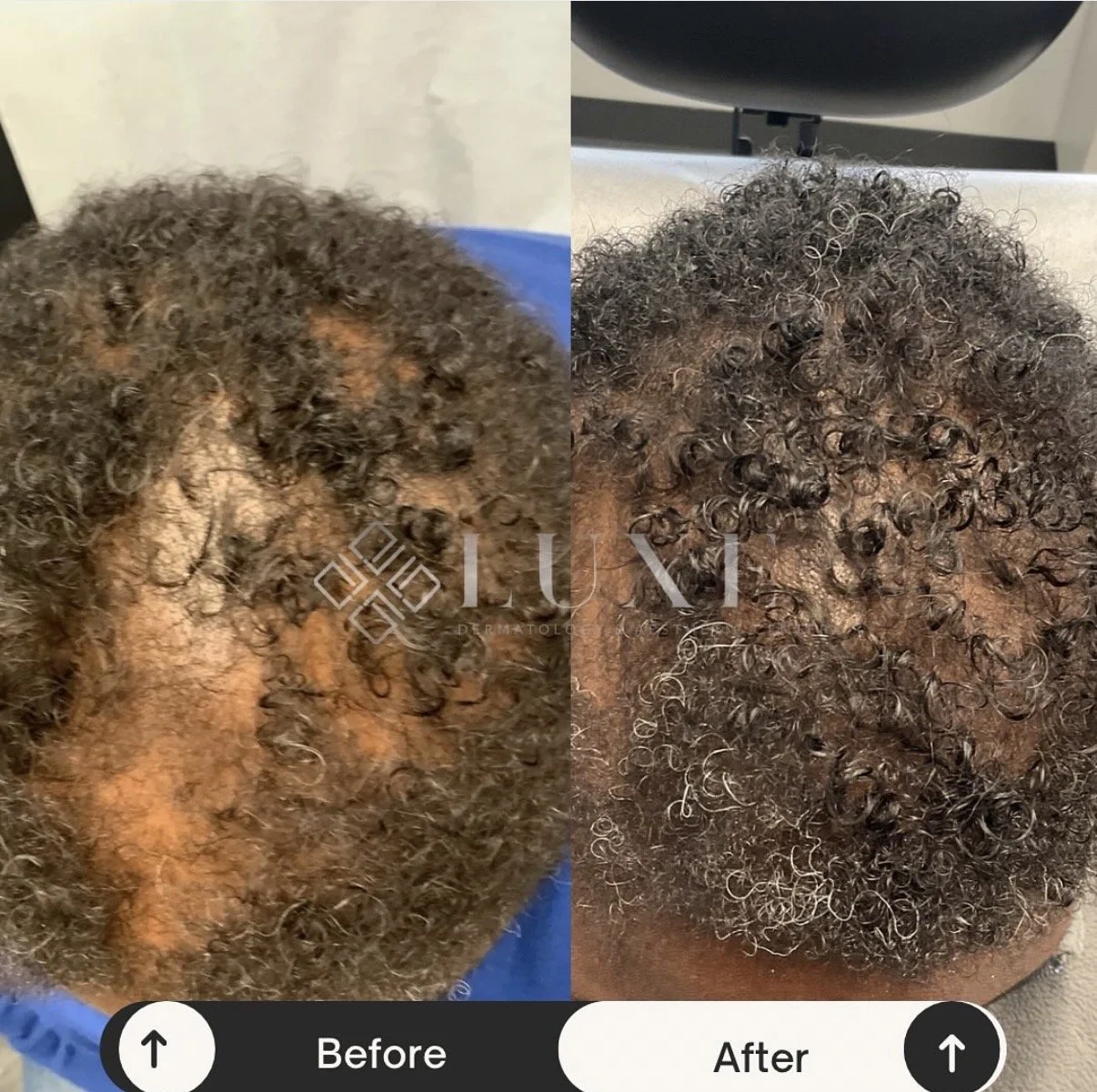 Hair Loss Is More Common Than You Think, And Treatable