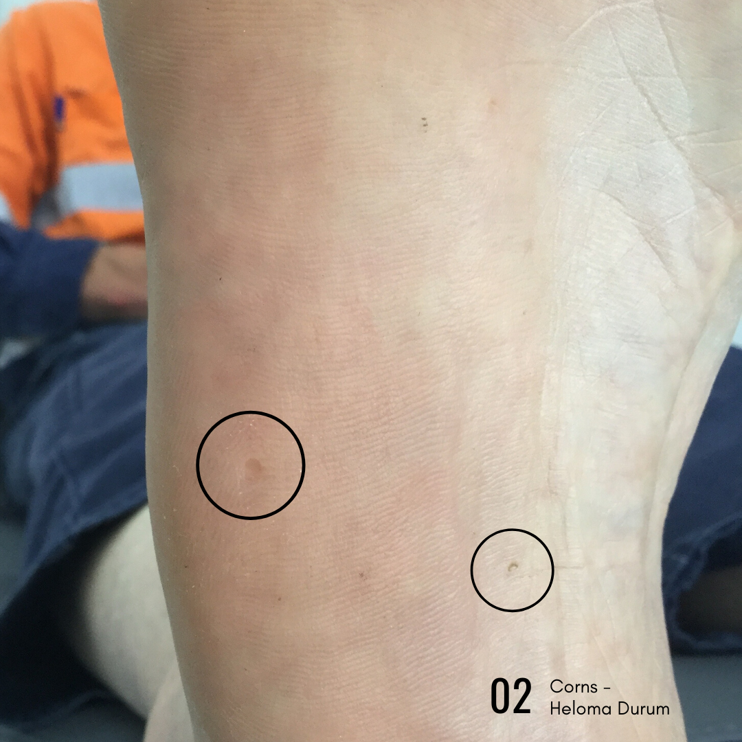 Corn vs. Wart How to tell the difference! — Sky Podiatry