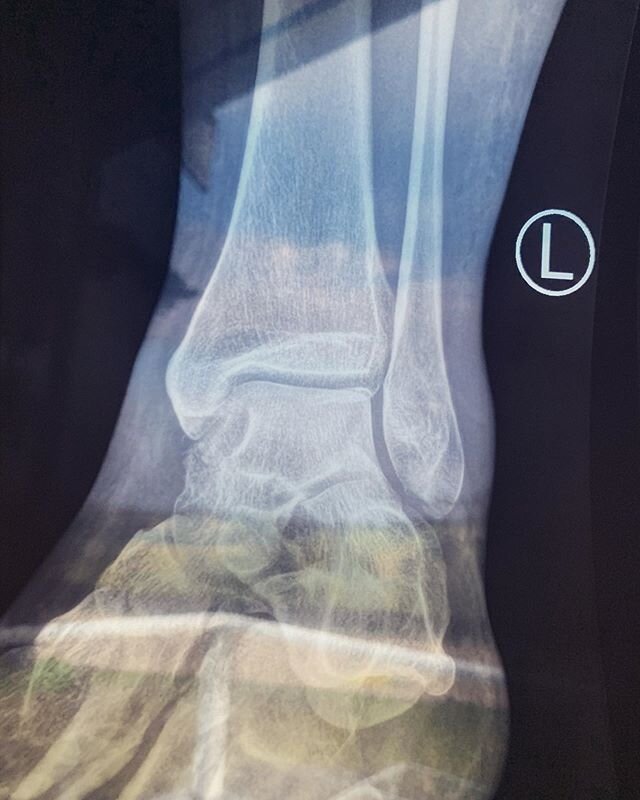 Spot the fractures. Two weeks down four to go. #moonboot