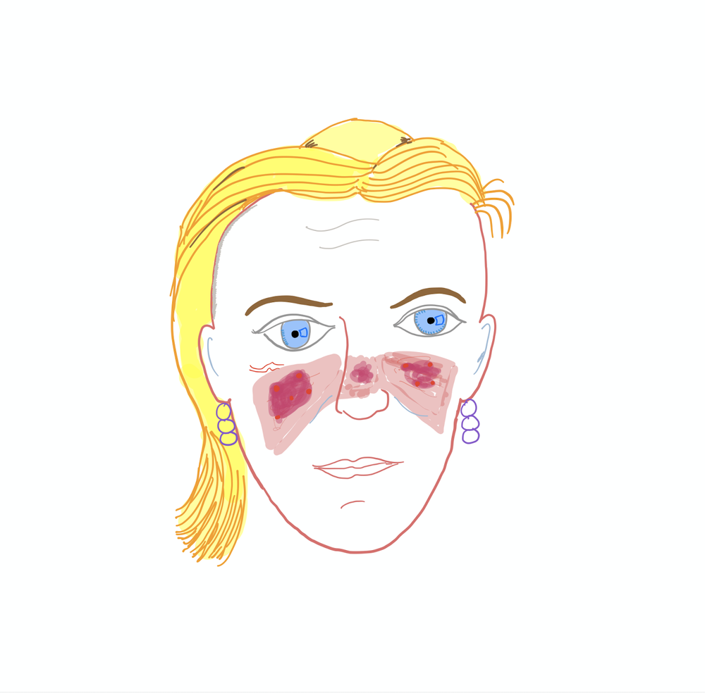 【Lupus】 494E3B8B-6F73-4112-A68B-