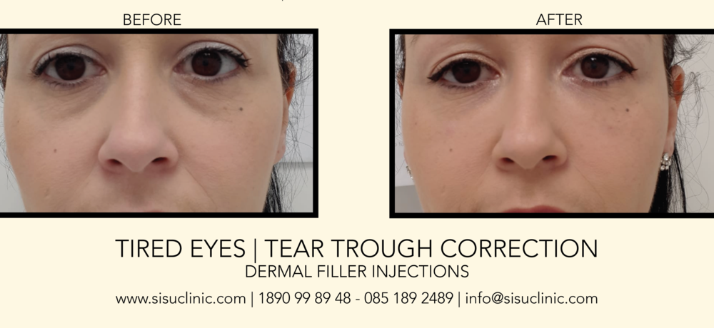 erase how to fix hollow sunken undereyes pic e1547557686884