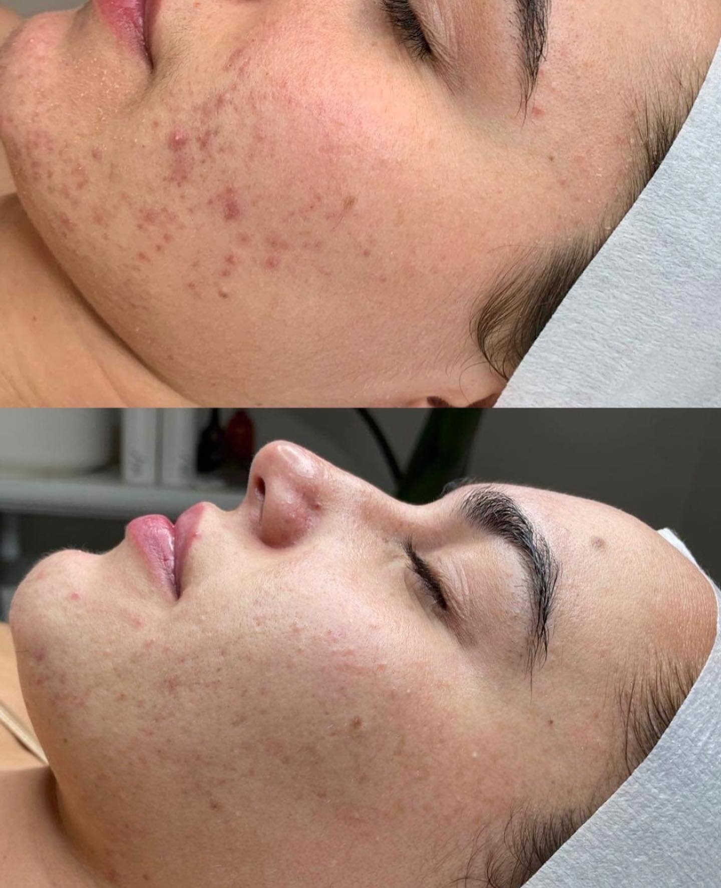 Results that speak for themselves ✨this client has made amazing process with being consistent with treatments and home care, we can&rsquo;t wait to see where her skin can go from here 😍