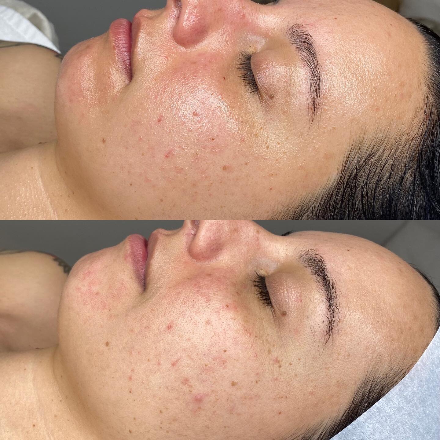 Okay wow the power of LED is realll, these pictures are with just 3 LEDs and home care. You can literally do 3 LEDs in one week and create this change within your skin 🤯.
Pigment, scaring and breakouts have reduced and skin is looking more healthy a