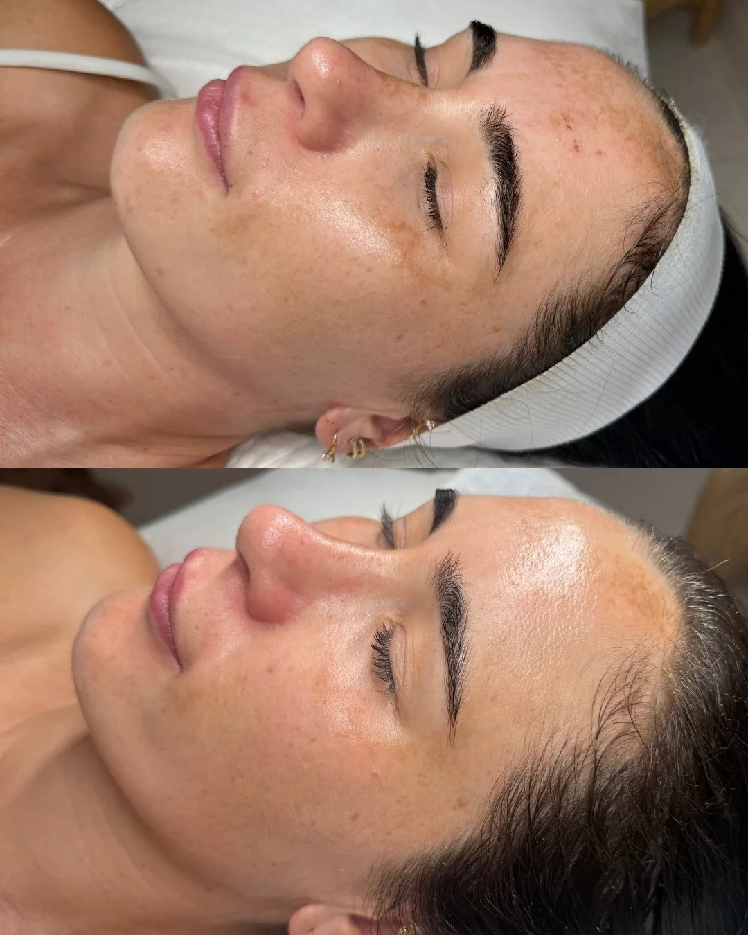 We love a good before and after! Naomi and our lovely client Ash have recently focused on breaking down hormonal pigmentation, these are Ash's results after her first Corrective Peel (C Peel). 🍃

The Herbal Aktiv plant based corrective treatment lif