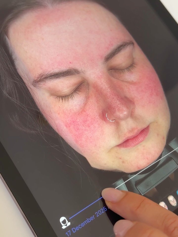 Healthy skin isn&rsquo;t an overnight success story. It takes time, consistency, and finally discovering what your skin craves (or doesn&rsquo;t). 

We can help with that! ✨ Whether you&rsquo;ve been visiting us for a while or looking to prioritise s