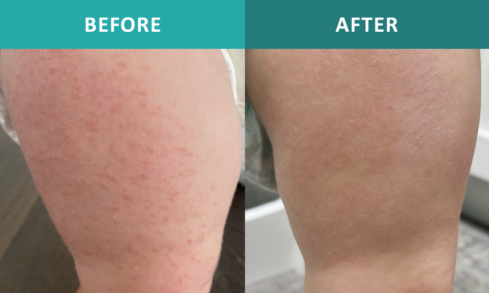 Natural Treatment for Rashes | Dermatologist Los Angeles