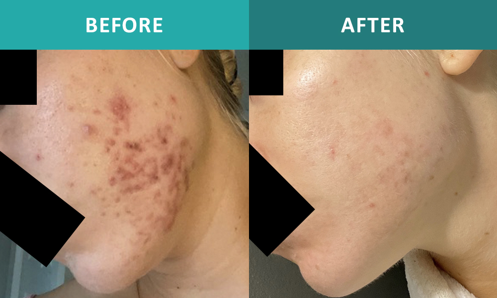 test_acne01.png