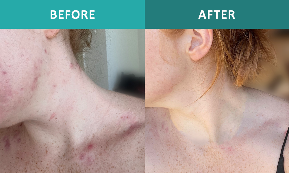 Pimples: Causes, Types & Treatment - Cleveland Clinic