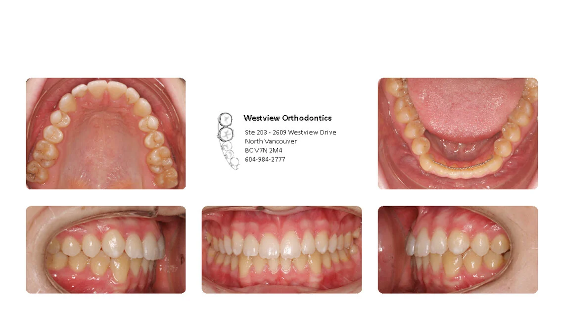 Missing or small teeth after treatment
