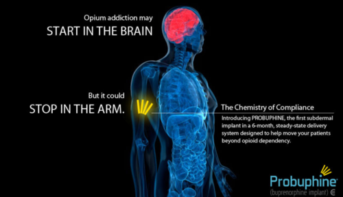 Probuphine Implant