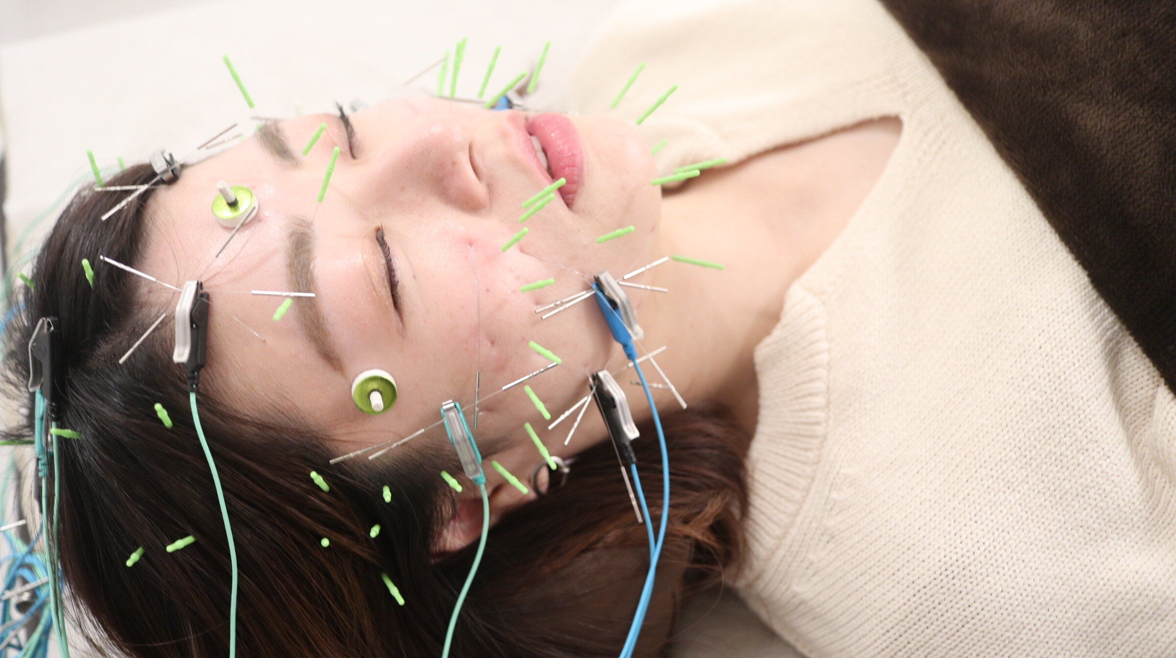 仙台の電気美容はり