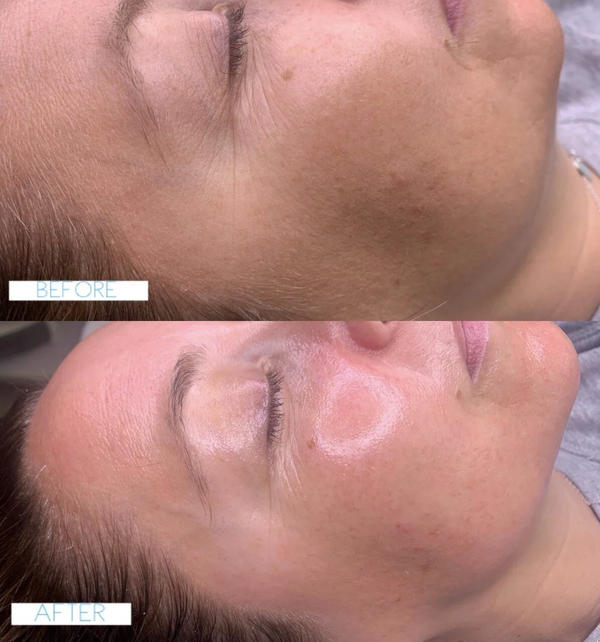 dermaplane facial