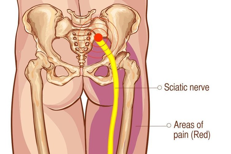 What is Sciatica? — Sobel Spine and Sports