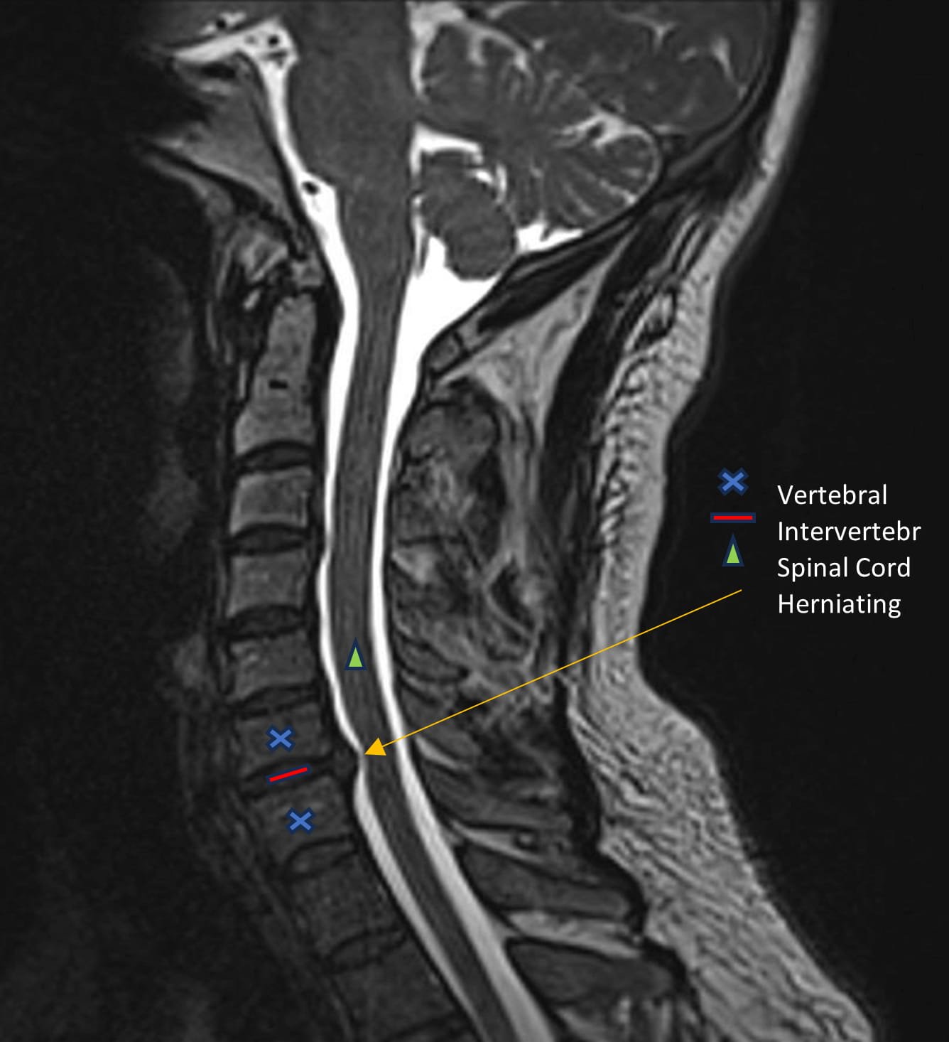 Cervical MRI showing disc protrusion causing neck pain treated at Sobel Spine and Sports Phoenix AZ