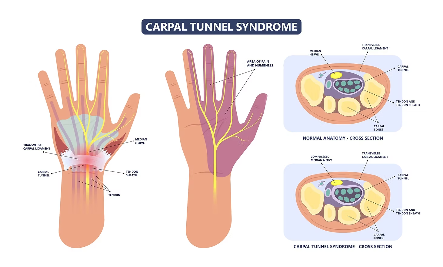 Diagram showing the carpal tunnel, median nerve, and surrounding structures in the wrist.