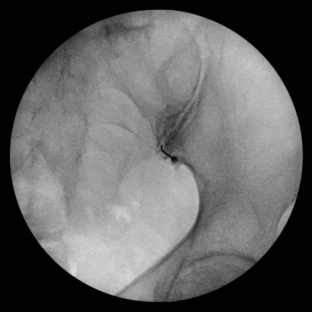 Sacroiliac joint injection procedure for SI joint pain relief at Sobel Spine and Sports Phoenix AZ