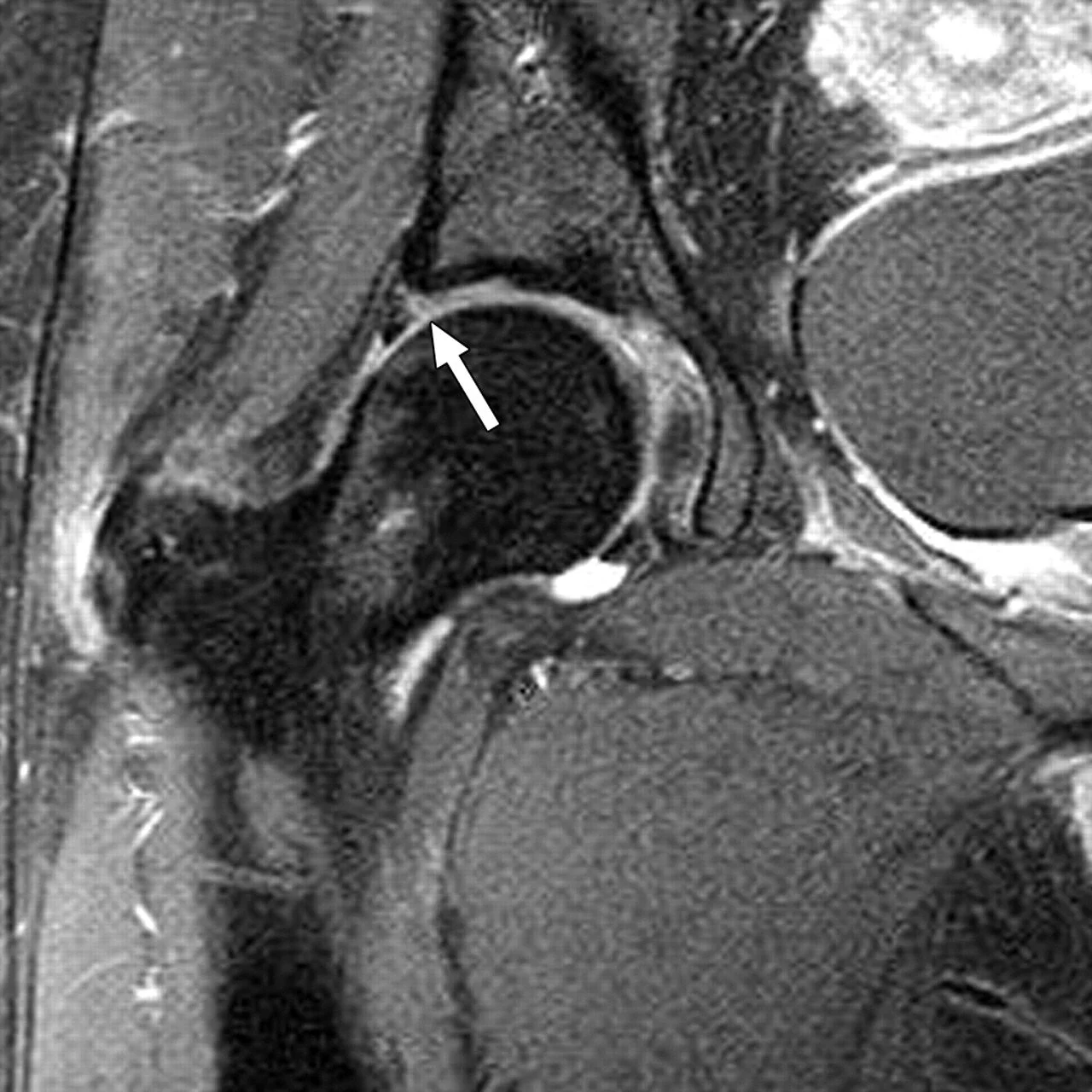 MRI image of a hip labral tear