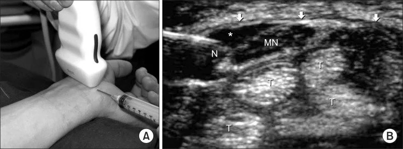 Ultrasound-guided corticosteroid injection for carpal tunnel syndrome.