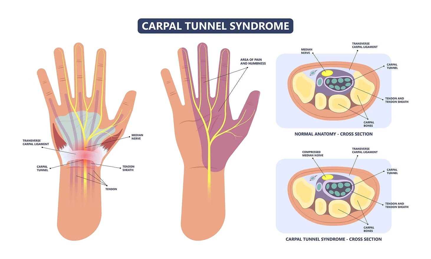 Carpal tunnel syndrome anatomy diagram showing median nerve compression and cross section of wrist treated at Sobel Spine and Sports Phoenix AZ