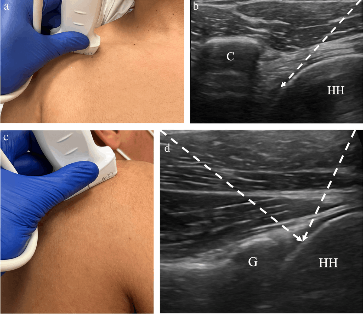Ultrasound guided injection for frozen shoulder treatment Phoenix A