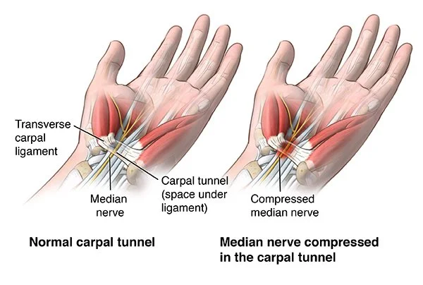 Diagram showing the carpal tunnel, median nerve, and surrounding structures in the wrist.