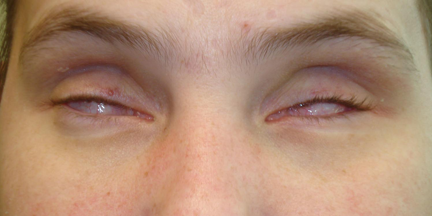 Ocular Prosthetics — Scott Fiscus, B.C.O.