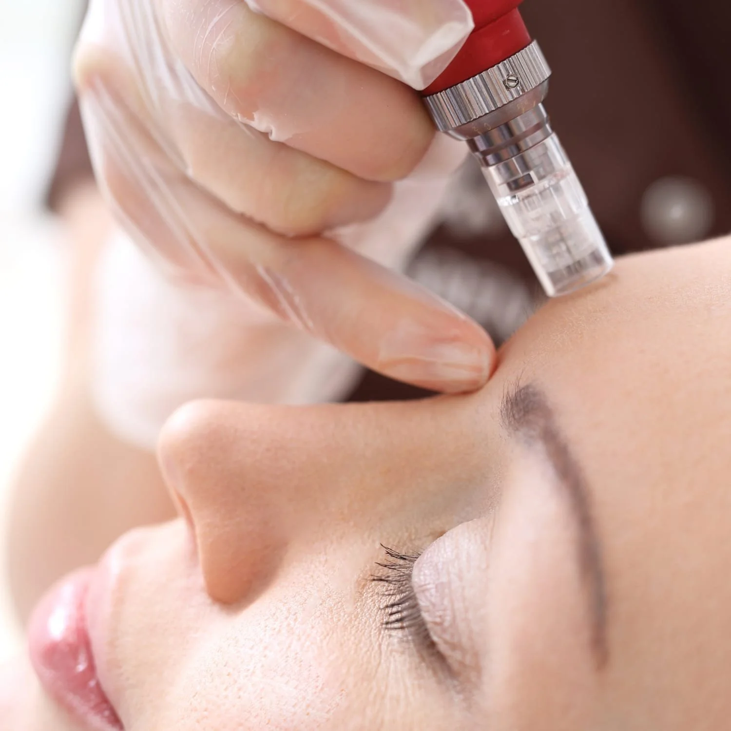 Microneedling: Benefits, Safety, and What to Expect