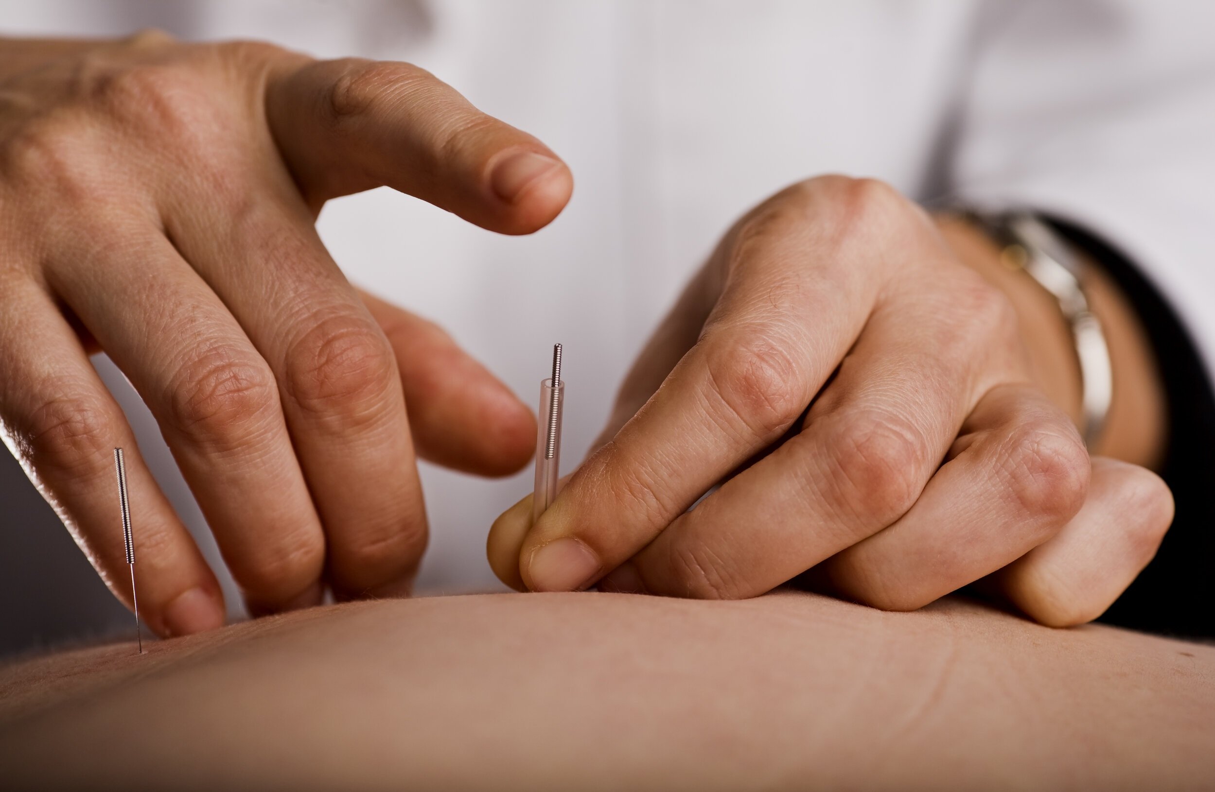 Acupuncture for Pain Management — Central Virginia Wellness Institute