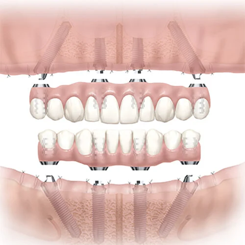 All on 4 Dental Implants Carmel, IN Bridgewater Dental Care