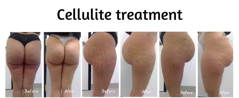 cellulite+treatment+izar+wellness+charlotte+nc.jpg