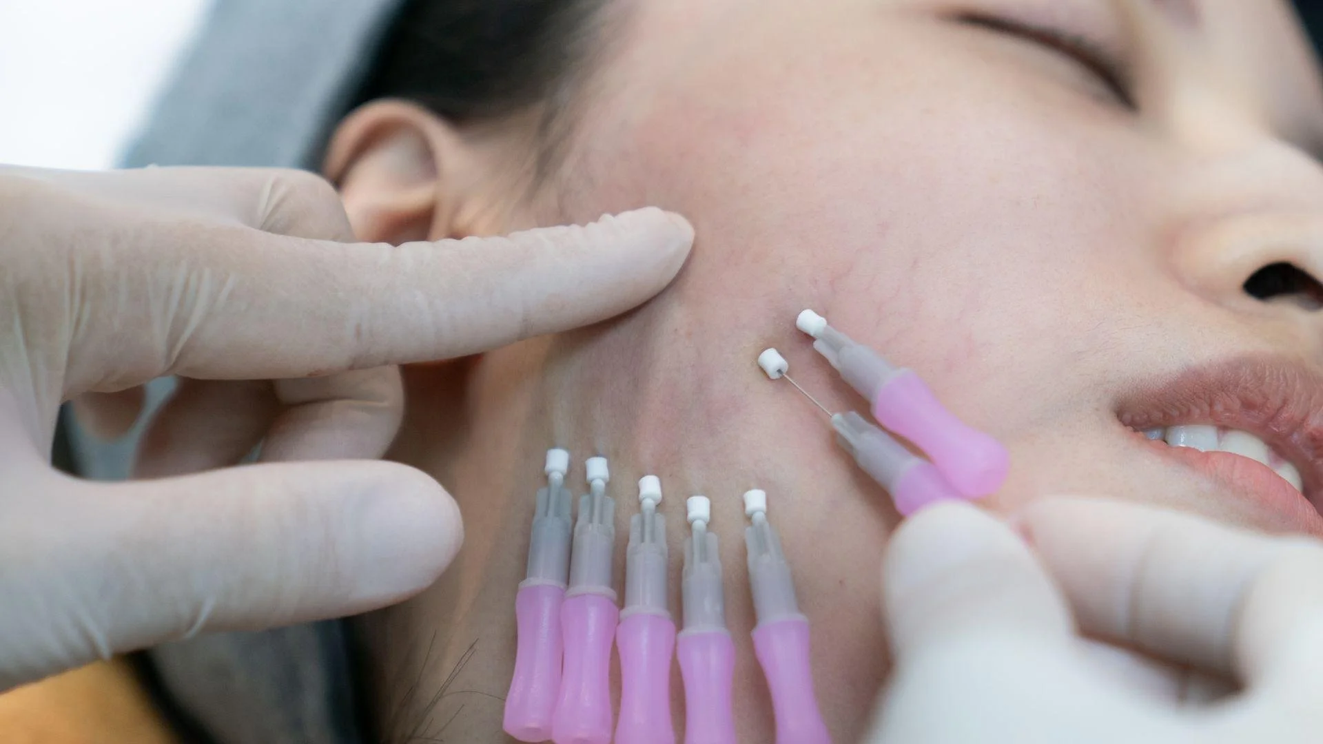 How Long Do Thread Lifts for Jowls Last