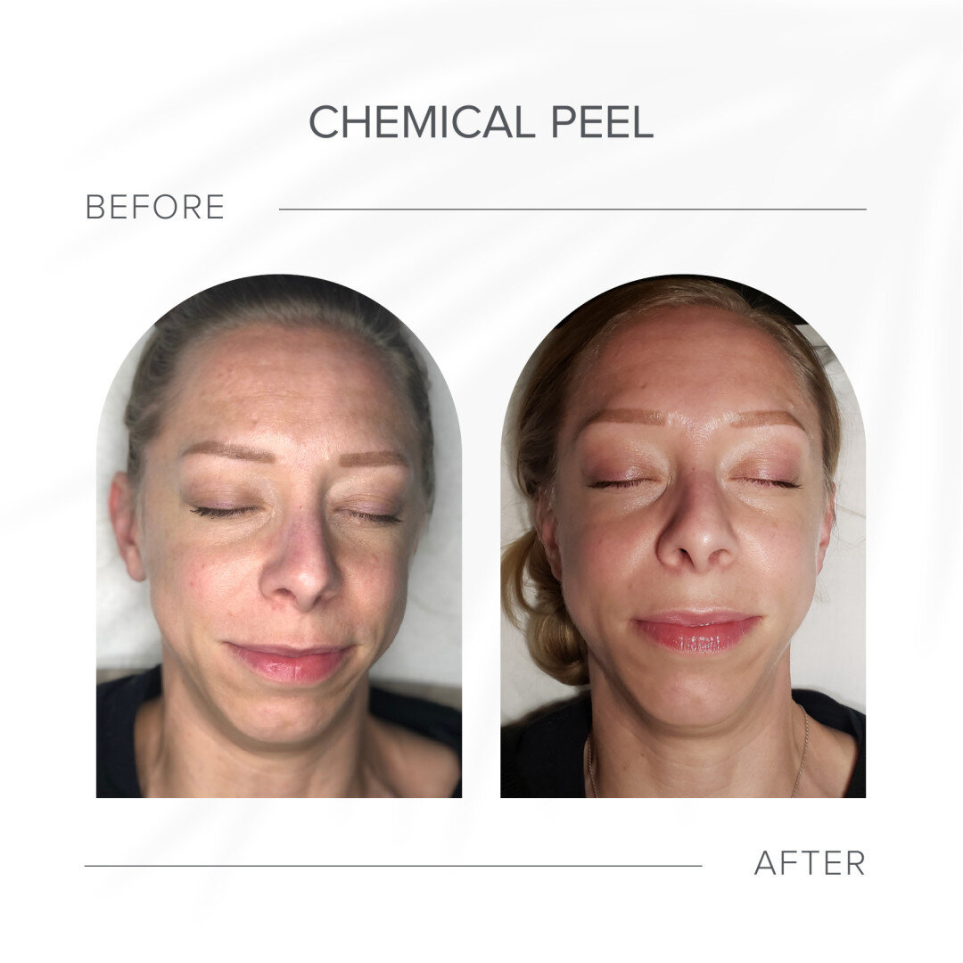 Ready to strip away imperfections and reveal new, radiant skin? 🌟

Our Chemical Peel treatment goes deep beyond the surface to transform your complexion from within.

Watch sun spots, fine lines, and acne scars fade away and book your session today!