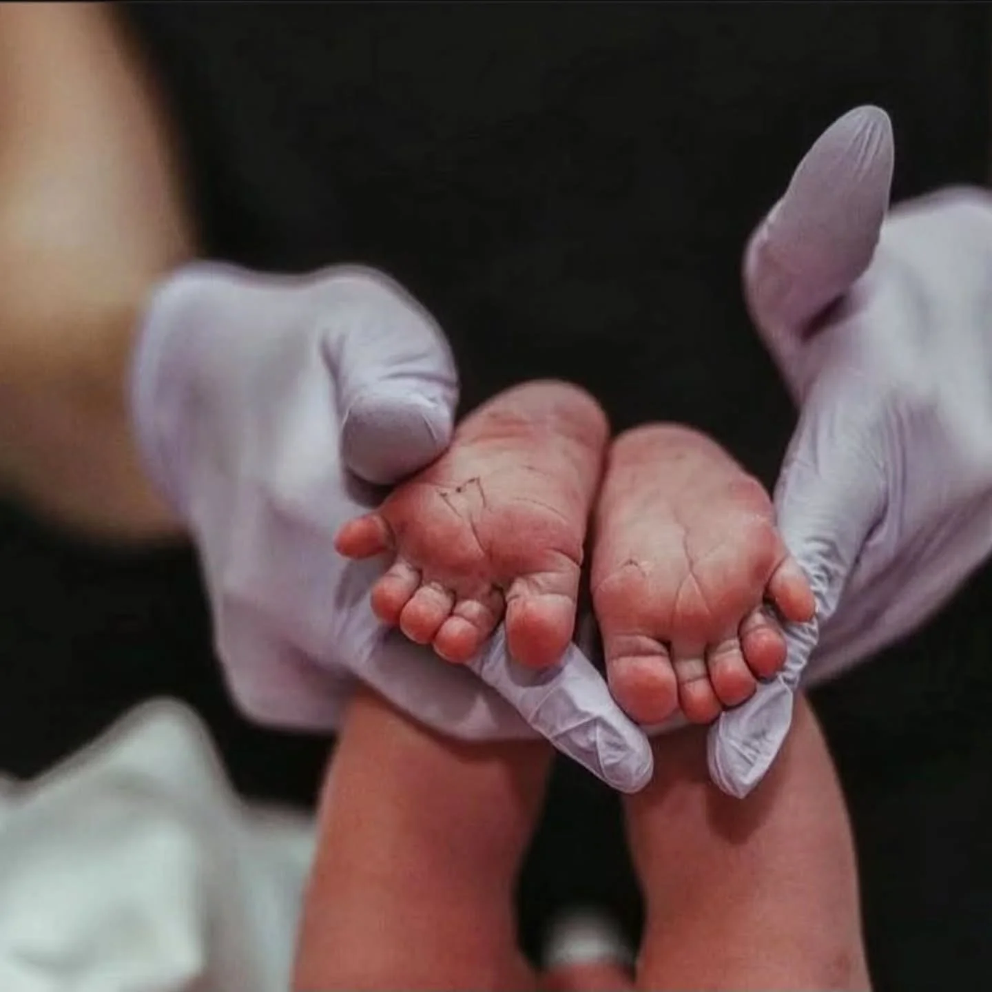 Did you know that the creases in a newborn's feet tell us a baby's gestational age? 

In general, full-term babies have creases that cover the entire sole of their feet. Premature babies, on the other hand, may only have creases on the front of their
