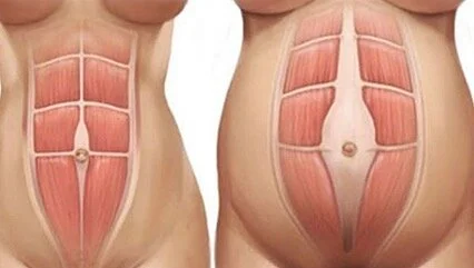Are you familiar with Diastasis Recti, a separation of your superficial abdominal muscles, the 6-pack muscles (rectus abdominis), caused by the widening of the linea alba, the connective tissue that runs vertically along your midline?

Symptoms inclu