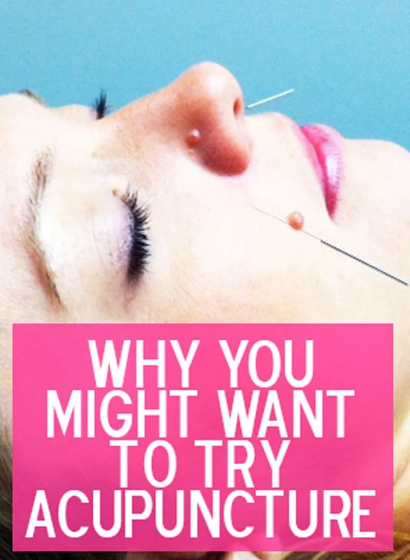 Should You Try Acupucnture? I Say Yes!