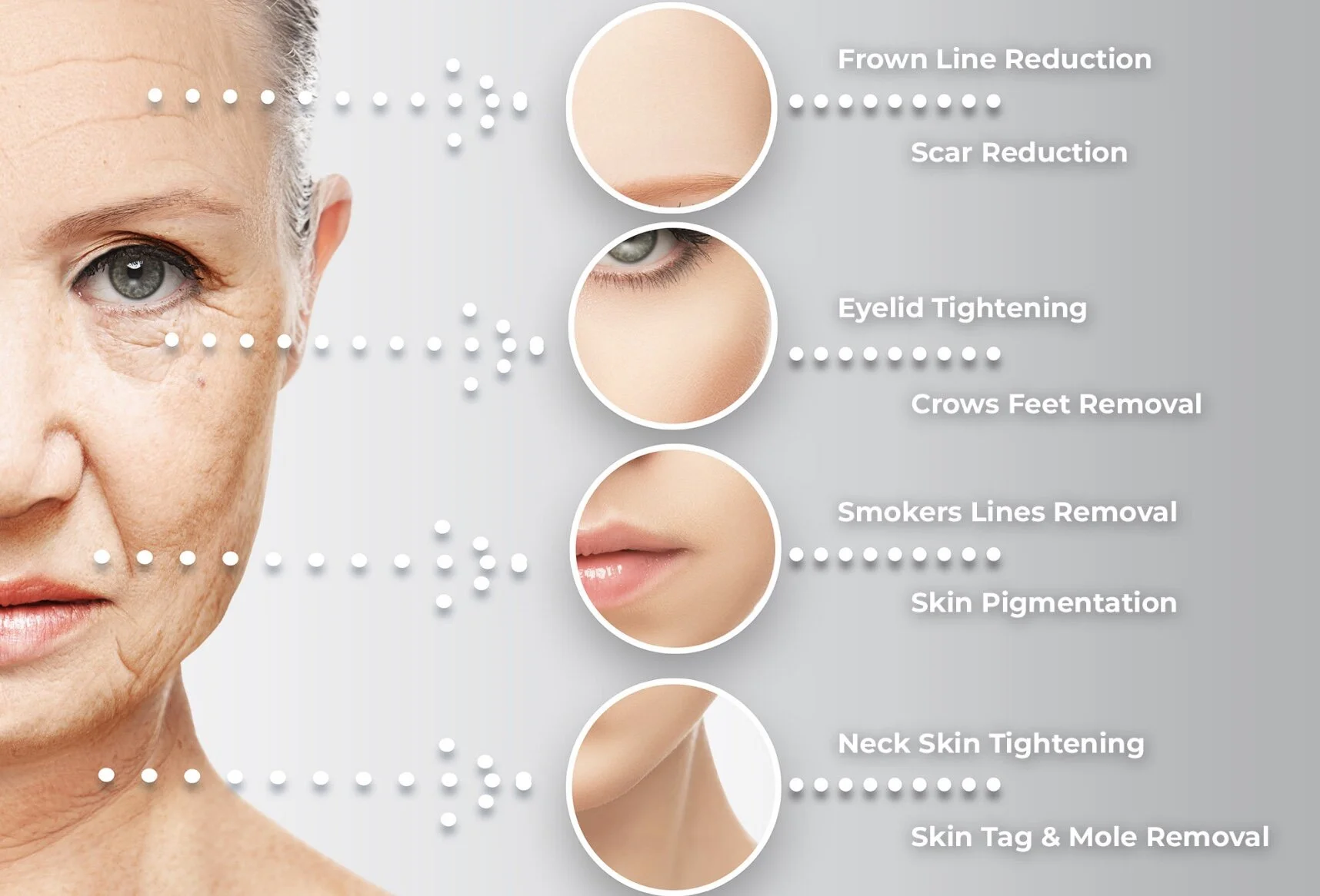 The Cosmetic Clinic — Plasma Pen | Surgery Free Face Lift