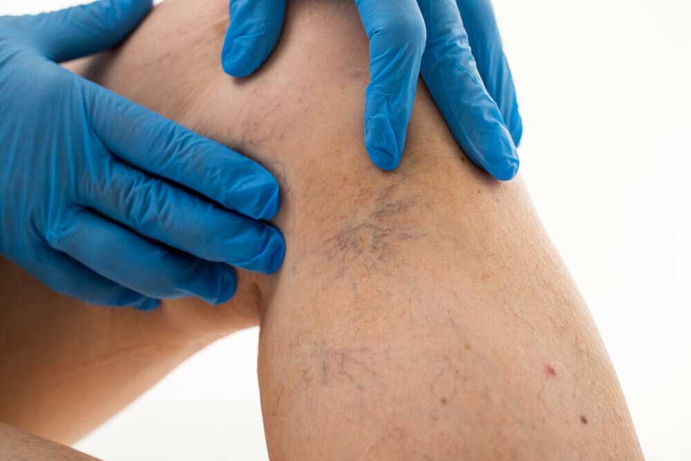 Varicose Veins 101: What really causes them and what can I do to prevent  and treat them? — Cosmetic Medical Clinic