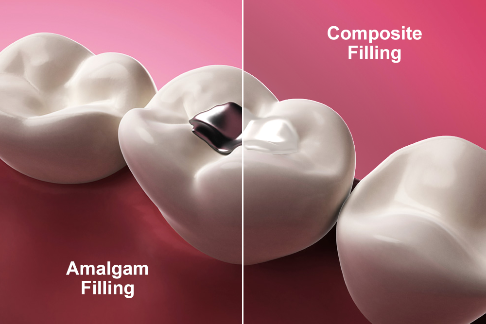 composite vs amalgam.png