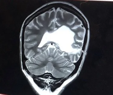 Where it all began with my epileptic broken brain