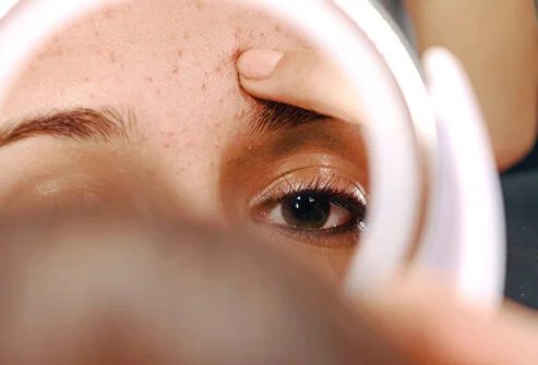 Acne and Eating: Is There A Correlation?