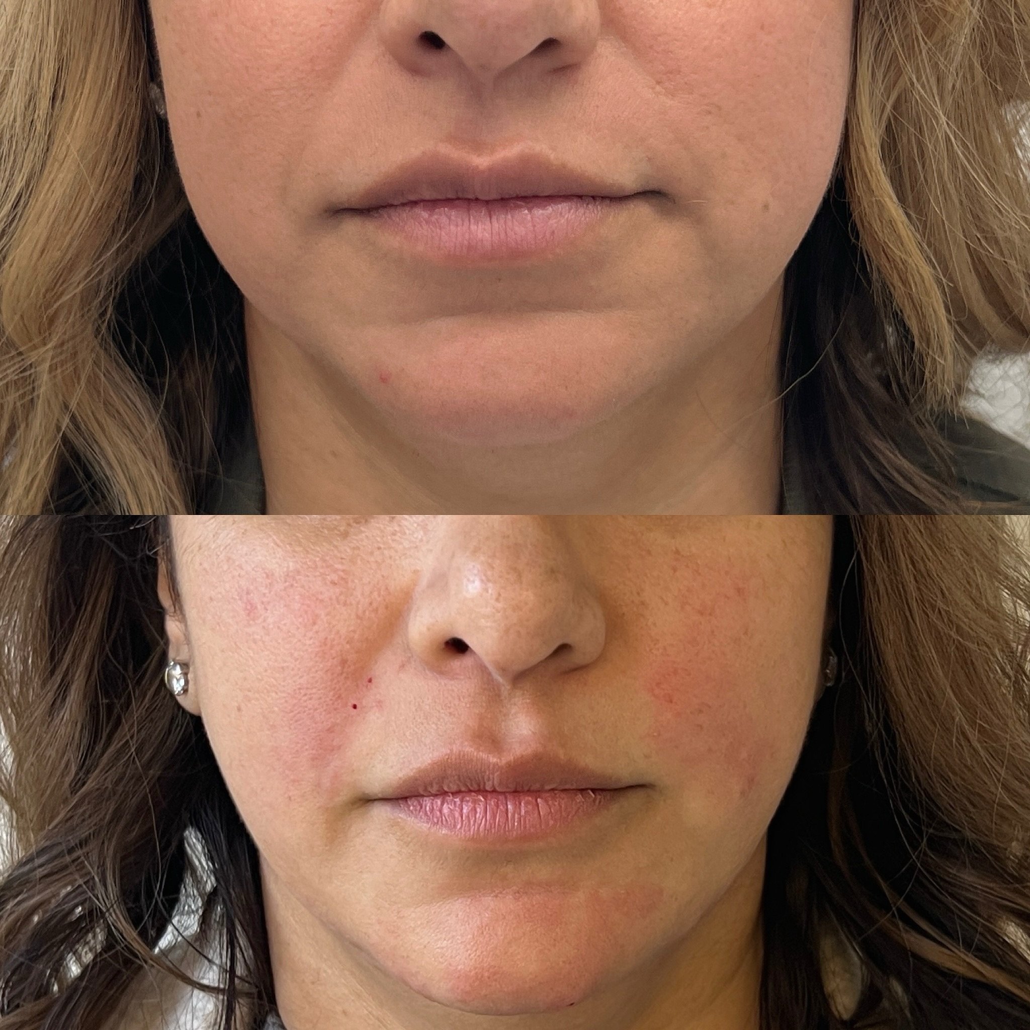 Lower face balancing with dermal fillers. We added a small amount of filler to the nasolabial folds (very superficially) and chin/chin shadow/jawline to let her natural beauty shine! This completed a full facial balancing treatment plan that also inc