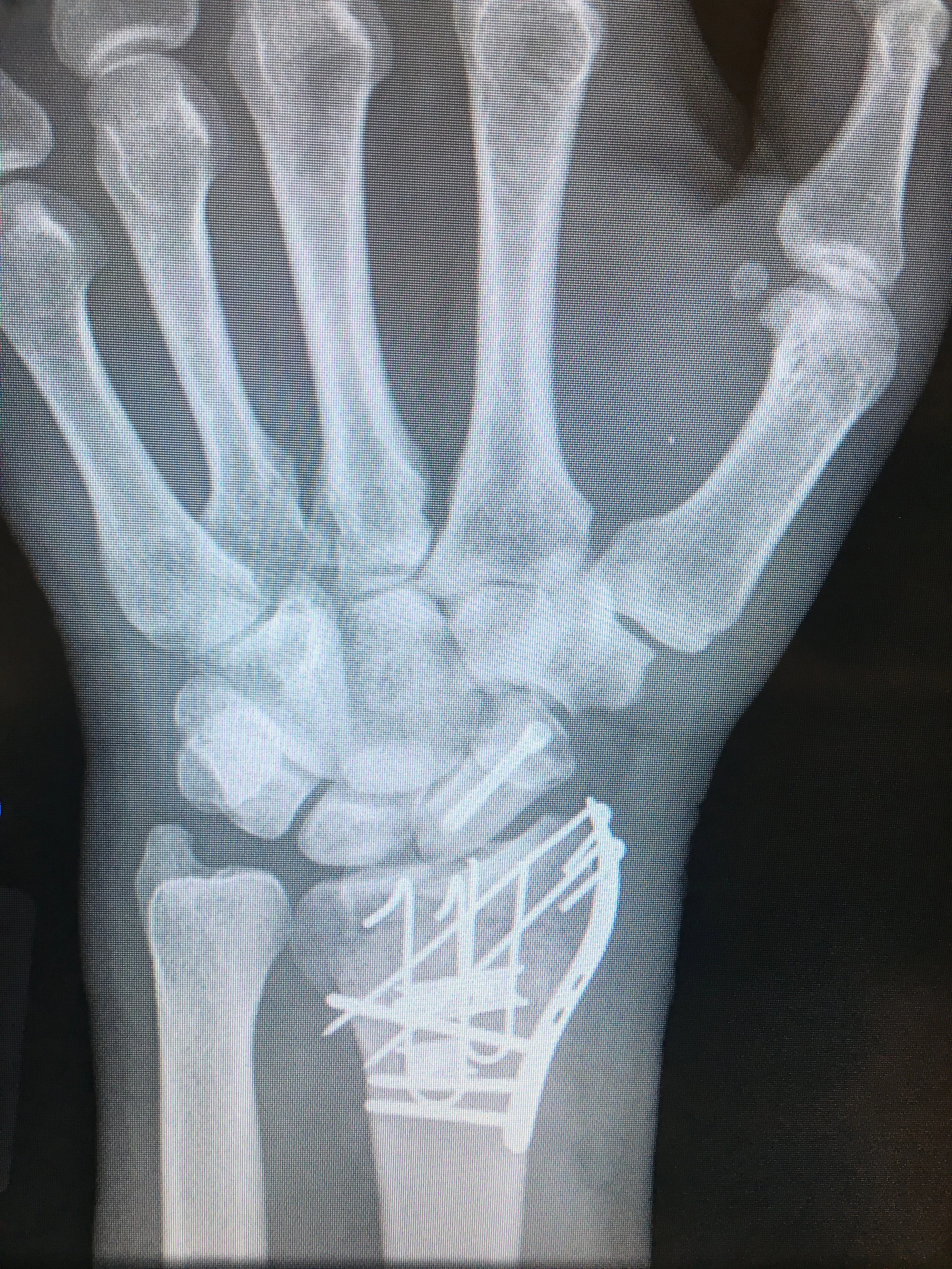 X-ray of a human wrist with metal plates and screws from orthopedic fixation.