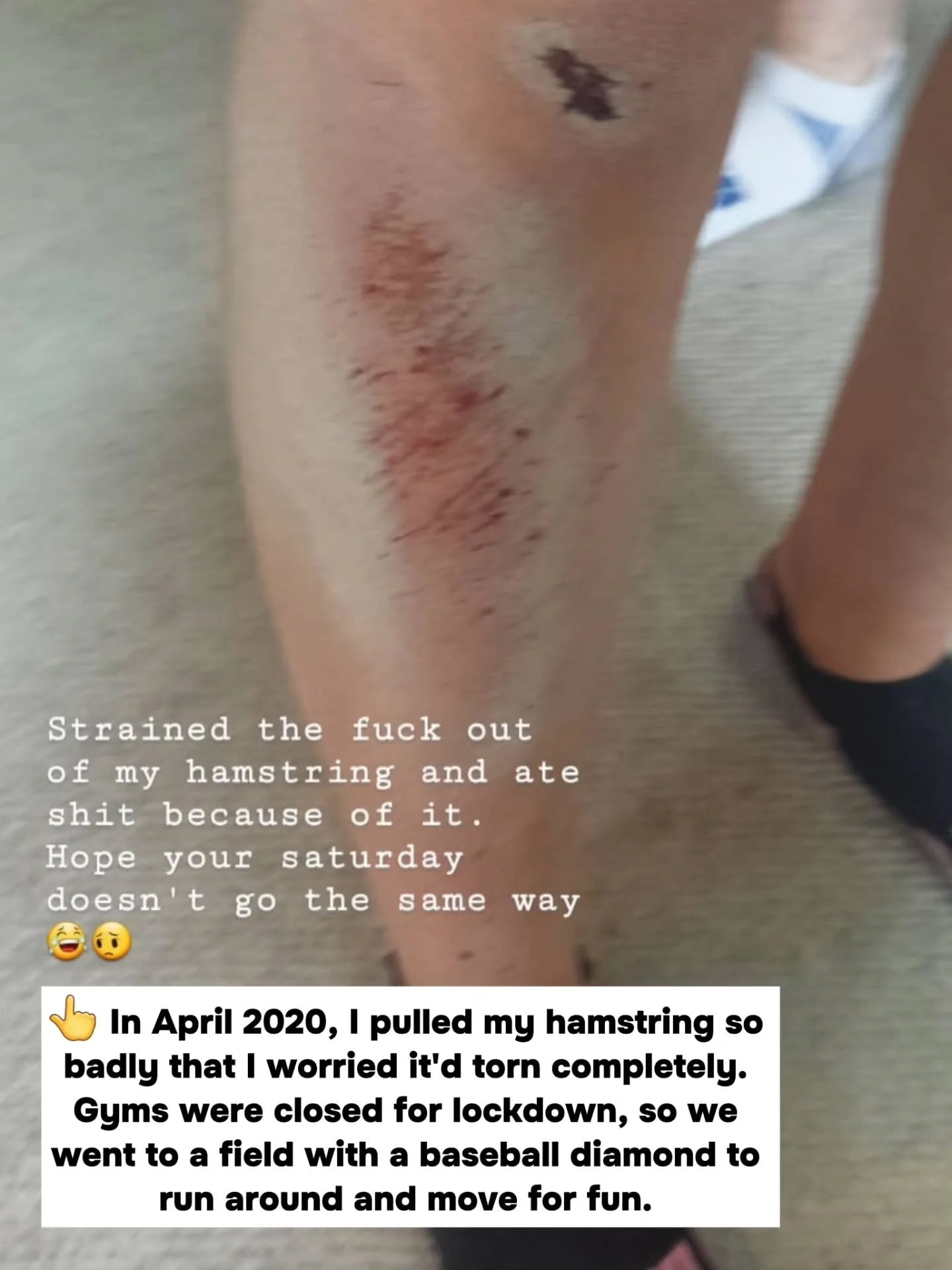 True (and rather embarassing) story 😬

In April 2020, I tore the absolute s*** out of my hamstring ❤️&zwj;🩹

The worst part? I knew it was a bad idea going into it.

Did I still do it? Yeup. 😅

For some reason, I assumed I'd still be able to do th